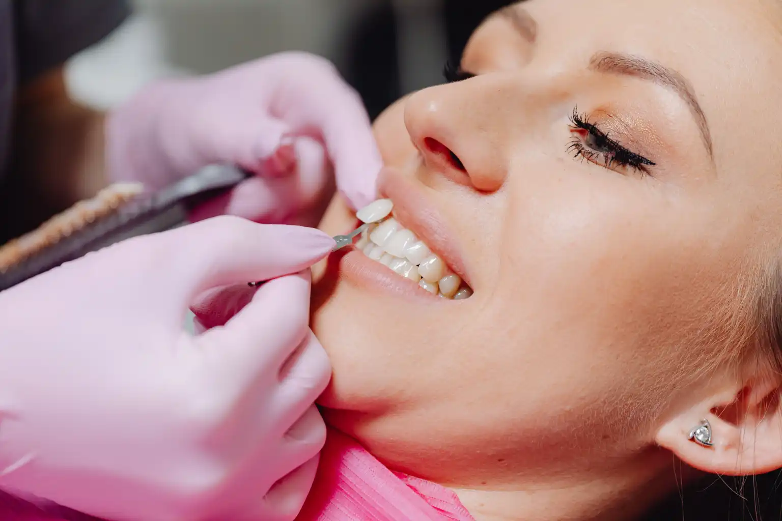 A close-up of a natural-looking smile after porcelain veneer treatment
