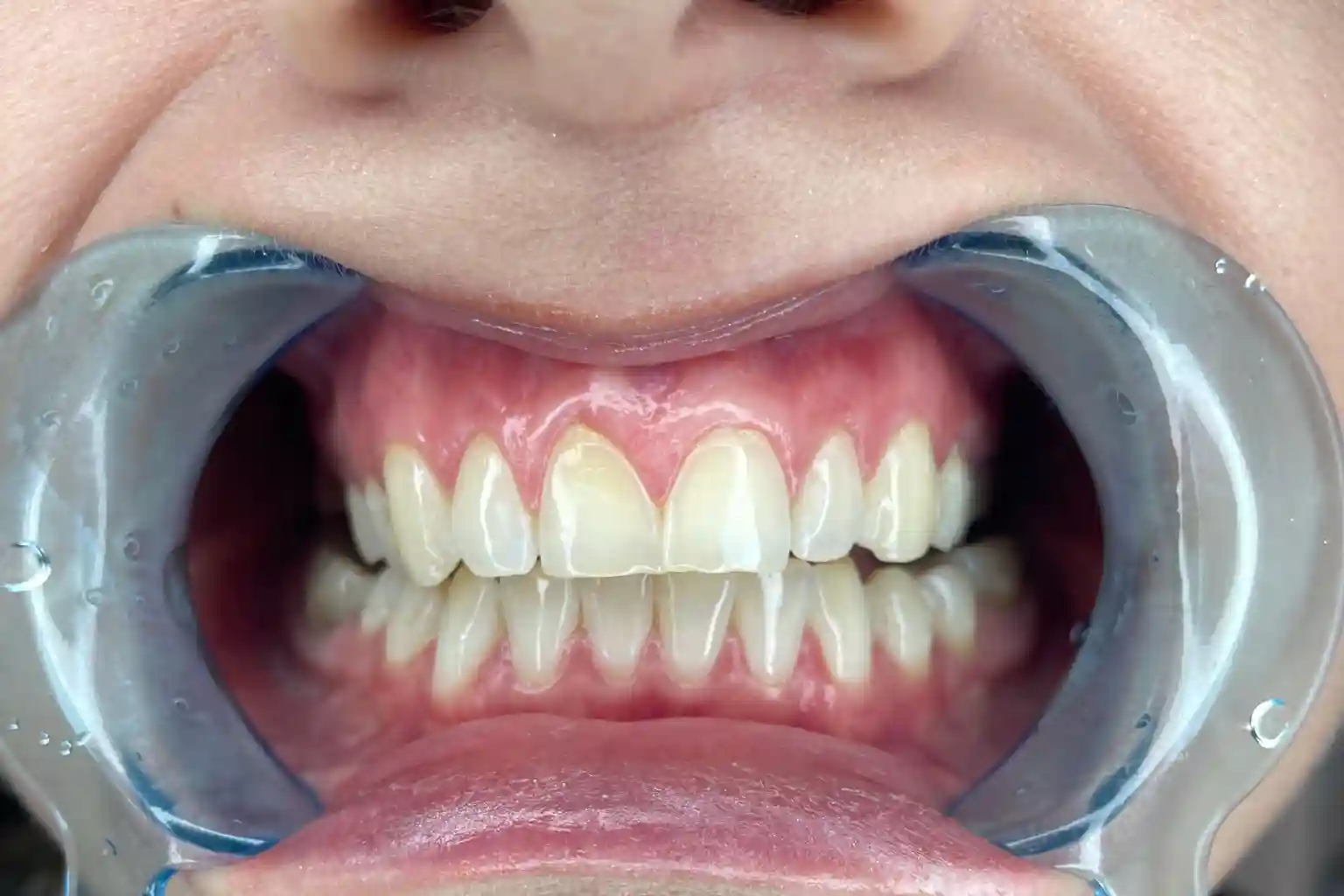 A close-up of an even gum line framing the upper front teeth
